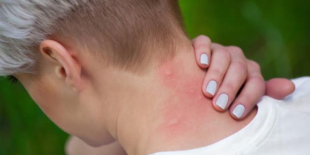 Rashes due to insect bites
